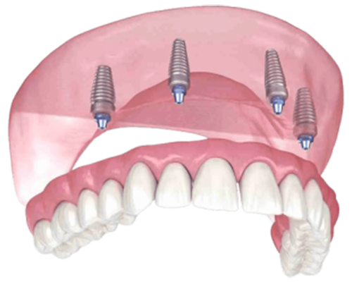 4 Implant Image