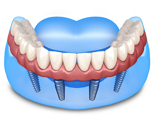 All-on-4 Dental Implants Image