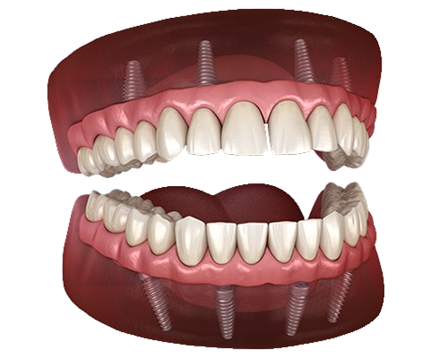 Permanent Zirconia Teeth Image